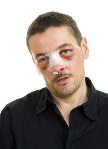 broken nose after fight