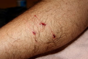 dog bite injury