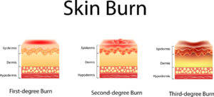 Attorneys for skin burns in Philadelphia 