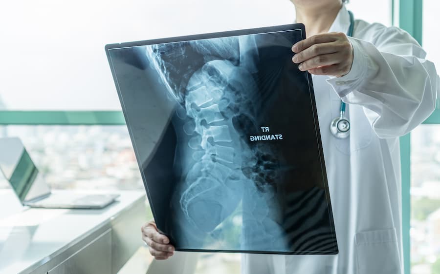 How Much Is My Spinal Cord Injury Worth in a Lawsuit?