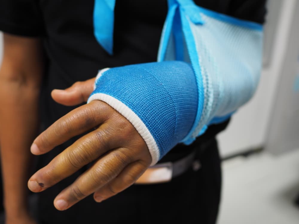 Injured arm resulting from an accident, encased in a protective plaster cast.